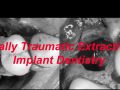 Minimally Traumatic Extractions in Implant Dentistry – Part 1