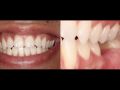 Online Continuum (Curriculum Series) - Integrated Implant Dentistry - Developing the Implant Tissue in the Transition Zone Part 2
