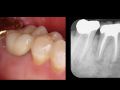 Online Continuum (Curriculum Series) - Guided Implant Surgery - Tips and Tricks