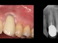 Online Continuum (Curriculum Series) - Combined Soft and Hard Tissue Grafting