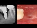 Continuum (Curriculum Series) - Surgical Removal of Osseointegrated Failing Implants