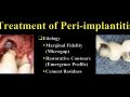 Continuum (Curriculum Series) - Treatment of Peri-implantitis