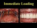 Continuum (Curriculum Series) - Surgical Treatment of Fully Edentulous Cases – Removable