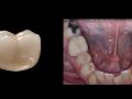 Continuum (Curriculum Series) - Restorative Implant Therapy - Partially Edentulous, Non-Esthetic Sites