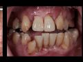 Continuum (Curriculum Series) - Restorative Implant Therapy - Fully Edentulous, Removable