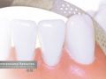 Clear Aligner Therapy and Interproximal Reduction